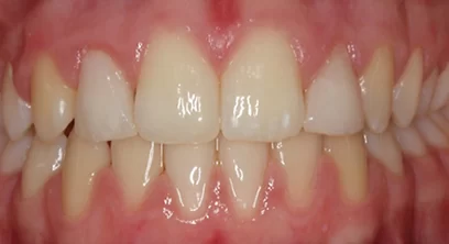 braces-after-03
