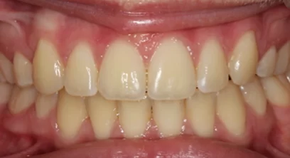 braces-after-04