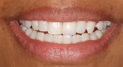 dental-implants-after-01