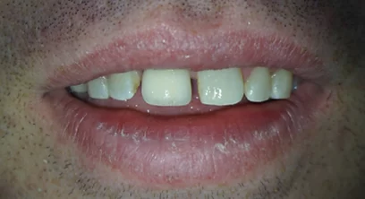 dental-implants-after-03