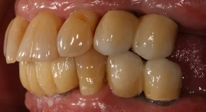 dental-implants-after-06