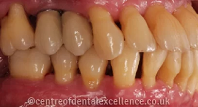 dental-implants-after-07