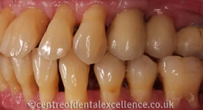 dental-implants-after-08