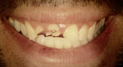 dental-implants-before-02