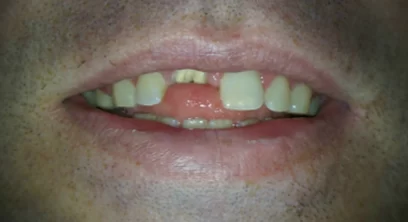 dental-implants-before-03