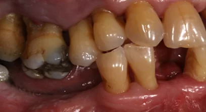 dental-implants-before-04