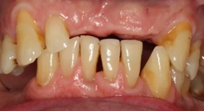 dental-implants-before-05