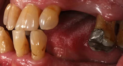 dental-implants-before-06