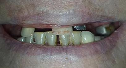 dental-implants-before-09