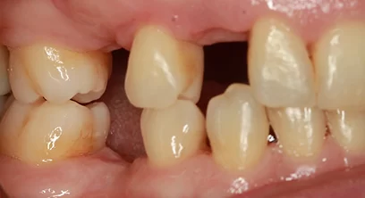 dental-implants-before-10