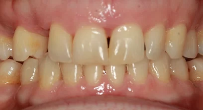 dental-implants-before-11