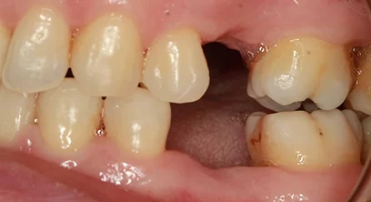 dental-implants-before-12