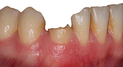 dental-implants-before-13