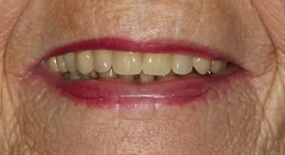 dentures-after-01