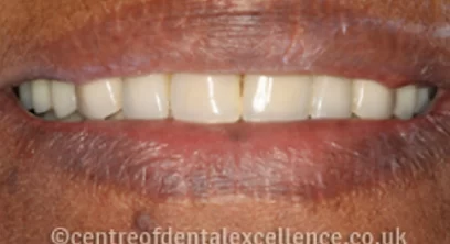 dentures-after-02