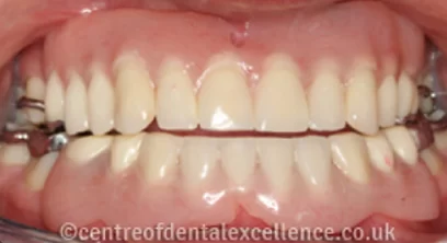 dentures-after-03