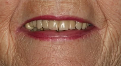 dentures-before-01