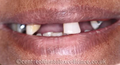 dentures-before-02