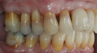 gum-disease-after-01