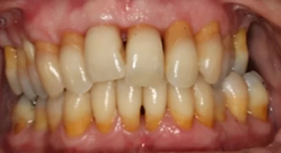 gum-disease-after-02