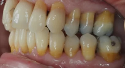 gum-disease-after-03