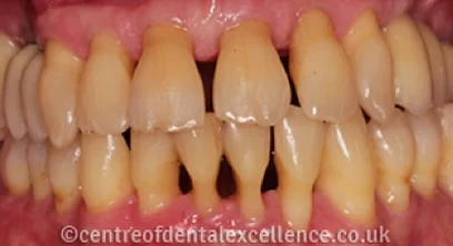 gum-disease-after-04