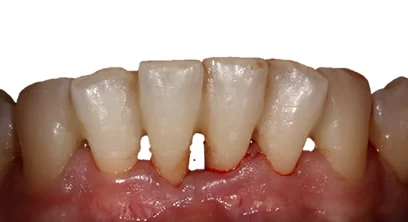 gum-disease-after-05