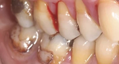 gum-disease-before-01
