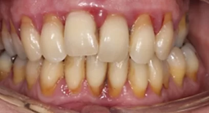 gum-disease-before-02
