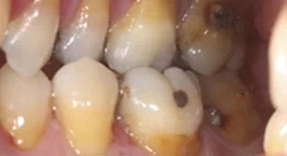 gum-disease-before-03