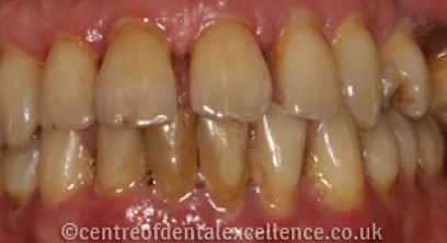gum-disease-before-04
