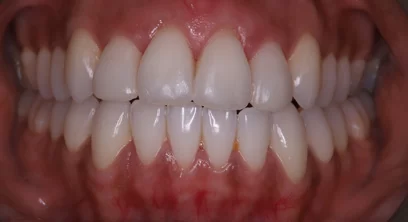invi-aft