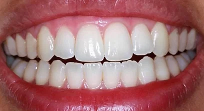 teeth-whitening-after-01 (1)