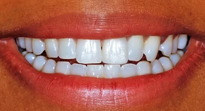 teeth-whitening-after-02 (1)