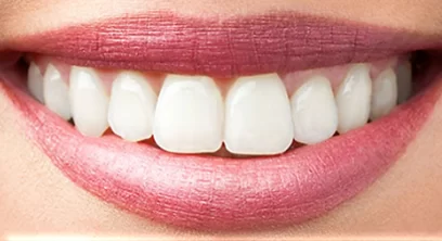 teeth-whitening-after-03 (1)