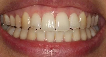 teeth-whitening-before-01 (1)