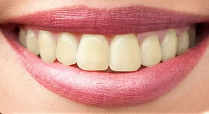 teeth-whitening-before-03 (1)