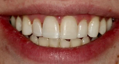 worn-teeth-after-02