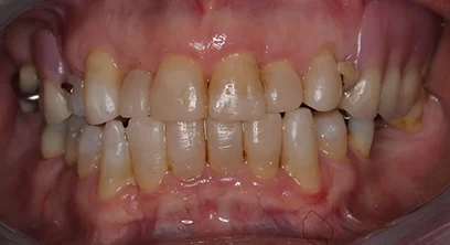 worn-teeth-after-03