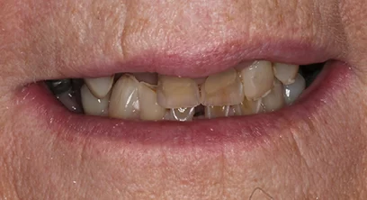 worn-teeth-before-01