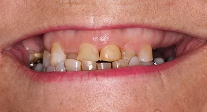 worn-teeth-before-04